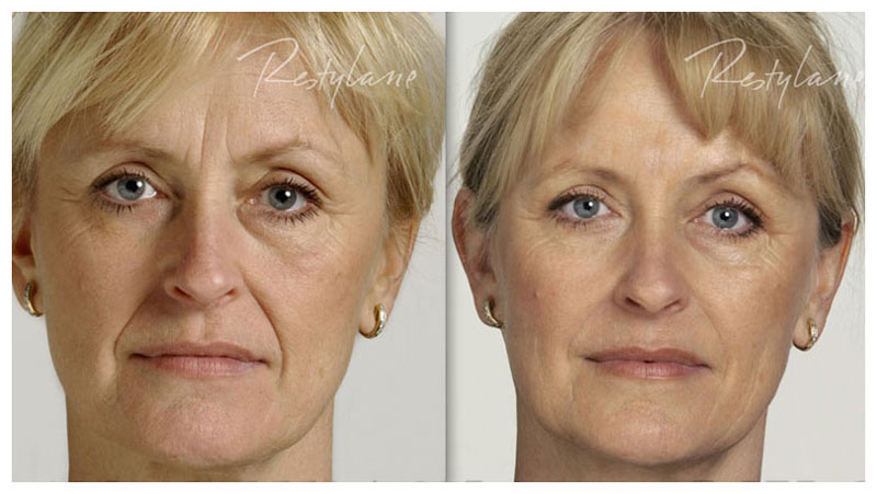 after filler - The North Dorset Clinic