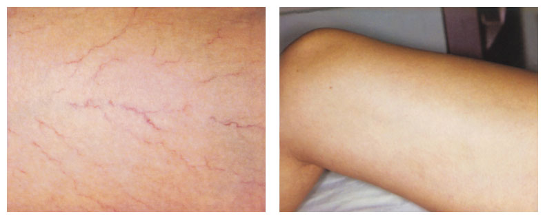 after photo for leg vein treatment using gentle yag laser - The North Dorset Clinic