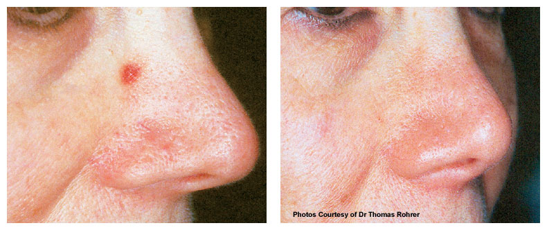 pre treatment photo of spider naevus - The North Dorset Clinic pre treatment photo of spider naevus - The North Dorset Clinic