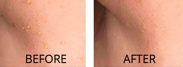 North Dorset Clinic Cryopen 3
